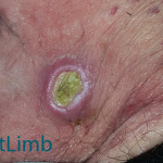 Medical_Issue_Ulcer_2