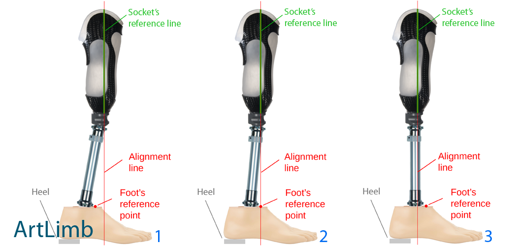 Prosthetic Socket Alignment: Front to Back